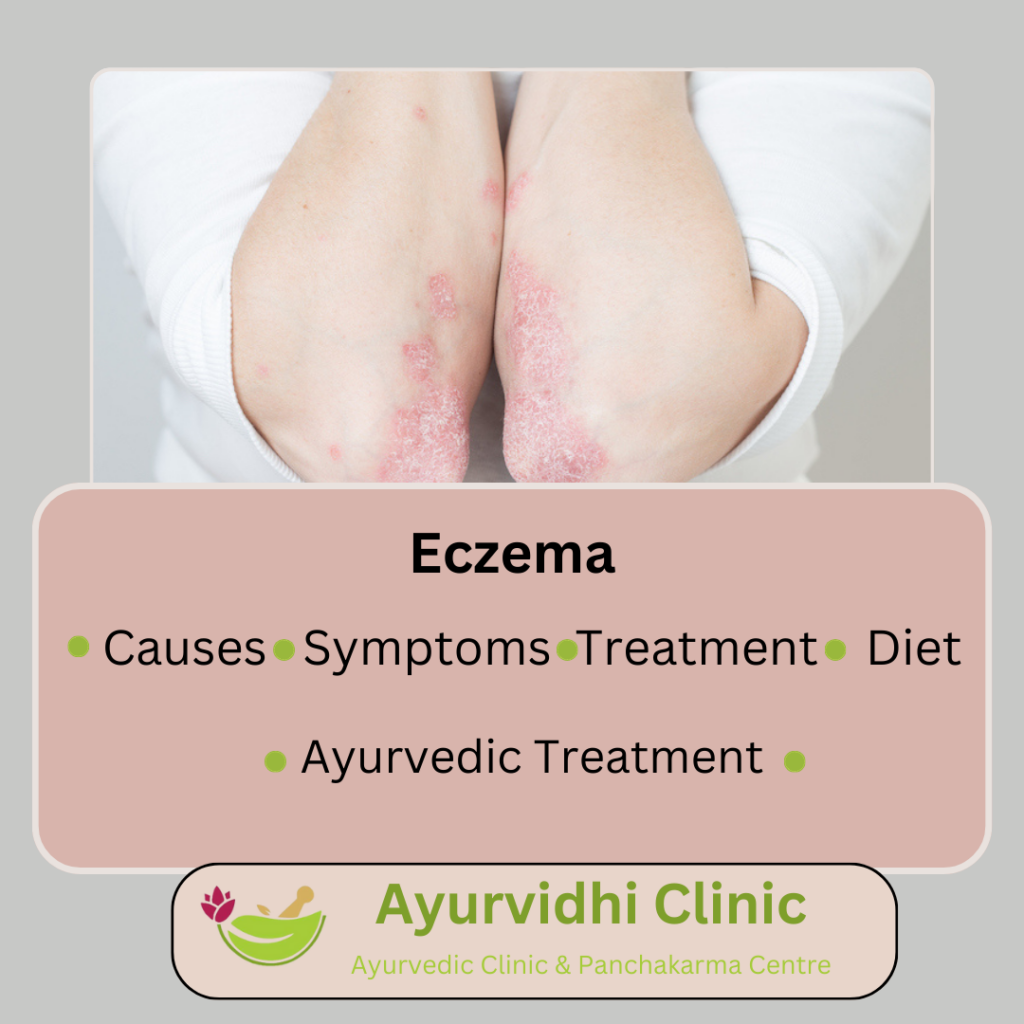 Ayurvedic and Panchakarma Treatment for Eczema: A Holistic Approach towards Skin Healing