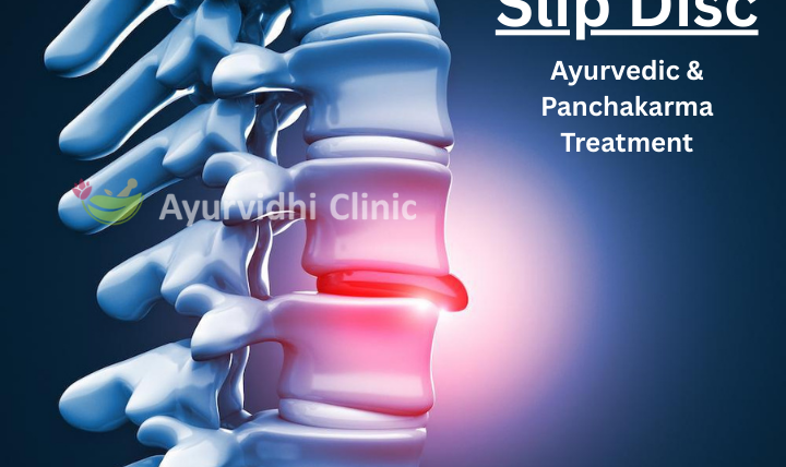 Ayurvidhi Clinic image showing a detailed spine with a highlighted slipped disc area, representing Ayurvedic and Panchakarma treatment for slip disc pain relief without surgery.