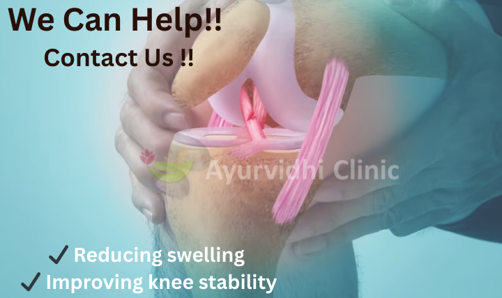ACL tear knee injury illustration with highlighted ligament damage and Ayurvedic treatment benefits for pain relief and healing at Ayurvidhi Clinic.
