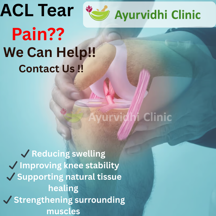 ACL tear knee injury illustration with highlighted ligament damage and Ayurvedic treatment benefits for pain relief and healing at Ayurvidhi Clinic.