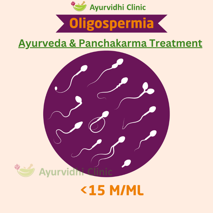 Oligospermia (low sperm count below 15 million/ml) illustrated with sperm cells — Ayurvedic & Panchakarma treatment for male infertility at Ayurvidhi Clinic